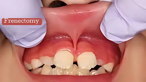 Frenectomy in Adults Comprehensive Guide to the Procedure and Its Benefits